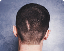 Cấy tóc che sẹo