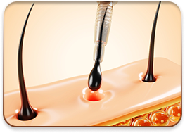 cấy ghép tóc y học quốc tế