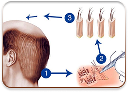 cấy ghép tóc y học quốc tế