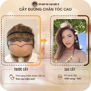 cấy ghép tóc y học quốc tế