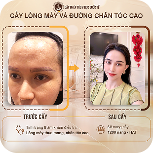 cấy ghép tóc y học quốc tế