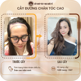 cấy ghép tóc y học quốc tế