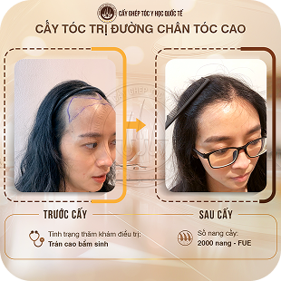 cấy ghép tóc y học quốc tế