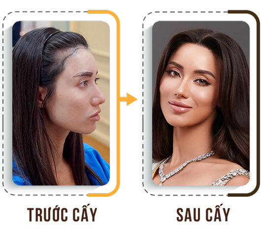 Cấy tóc việt nam