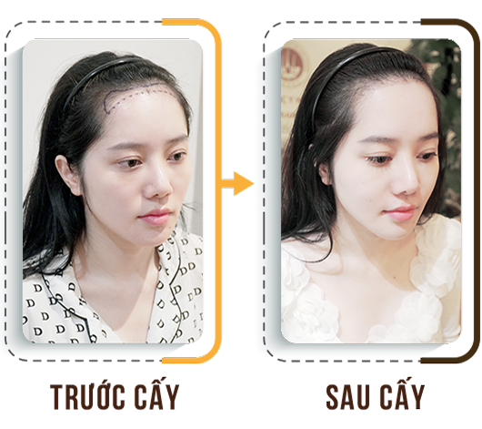 Cấy tóc việt nam