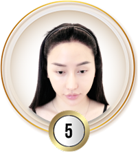 Cấy tóc việt nam