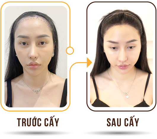 Cấy tóc việt nam