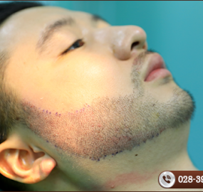 Cấy râu cho nam giới và những điều cần biết?