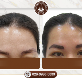 Cấy lông mày là gì? Có phải phương pháp làm đẹp lông mày tối ưu nhất hiện nay?