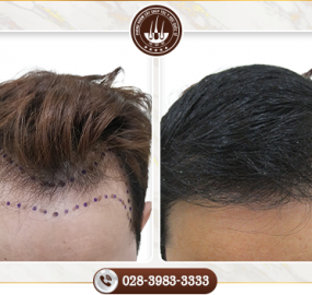 Cấy tóc mất bao nhiêu tiền? Khi nào thì cần cấy tóc?