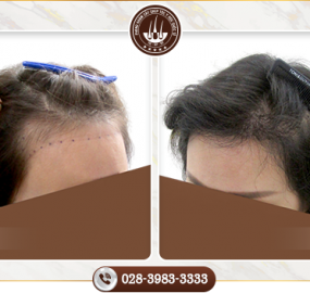 Khám phá cách trị hói tóc ở nữ tốt nhất hiện nay