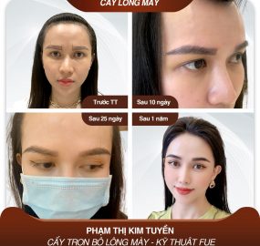 Địa chỉ cấy lông mày tại HCM uy tín và an toàn nhất