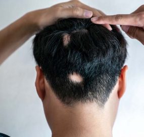Rụng tóc từng mảng nguyên nhân, triệu chứng và cách điều trị