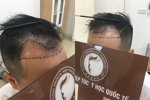 Nguyên nhân và cách điều trị bệnh hói đầu