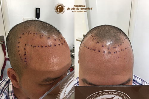 7 cách trị hói đầu và rụng tóc an toàn hiệu quả cho cả nam và nữ giới