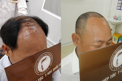 Bệnh hói đầu có chữa được không?