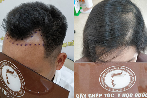 5 sai lầm trong cách chữa hói đầu tại nhà