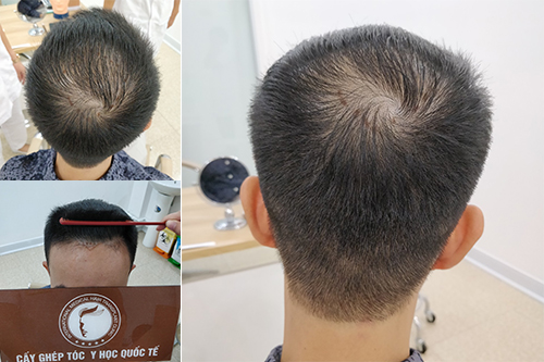 CÁCH TRỊ HÓI ĐỈNH ĐẦU: ĐÂU MỚI LÀ GIẢI PHÁP HIỆU QUẢ NHẤT?