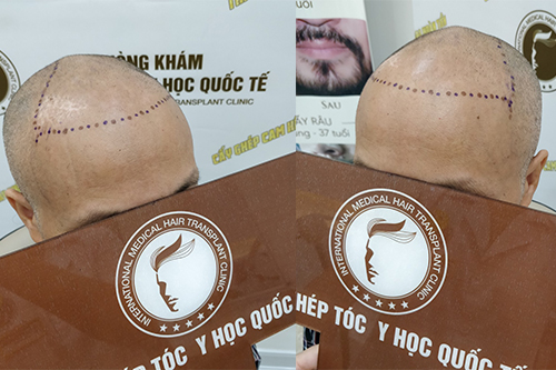 Tiết lộ một số cách chữa hói đầu ở nam giới khoa học, an toàn, hiệu quả