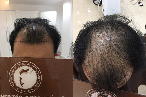 5 Cách trị hói đầu hiệu quả kích thích mọc tóc nhanh