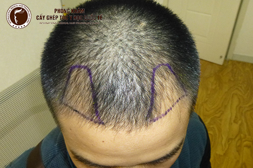 Giải đáp: Cấy tóc giá bao nhiêu?