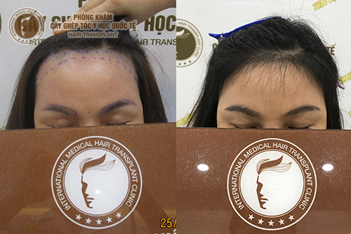 Review chi tiết: Phương pháp cấy chân mày tự thân