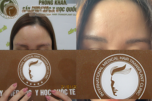 Chi phí cấy lông mày trong nước có cao không?