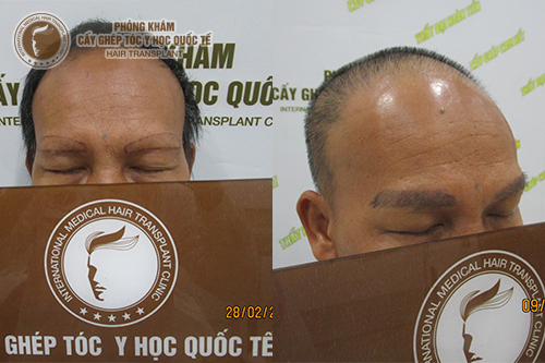 Cấy chân mày nam giới phương pháp cải thiện “tướng số” cho phái mạnh