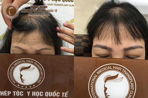Review bảng giá cấy chân mày tại phòng khám cấy ghép lông mày uy tín