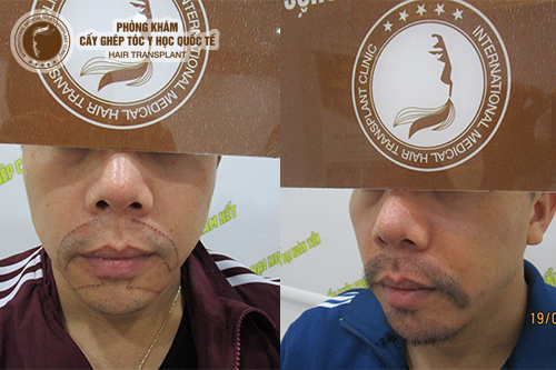 Cấy râu thẩm mỹ – phương pháp “lột xác” vẻ ngoài nam tính cho cánh mày râu