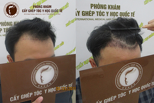 Cận cảnh quy trình cấy tóc diễn ra như thế nào?