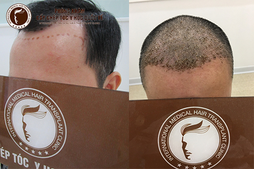 Giải pháp cấy mọc tóc nào hiệu quả nhất hiện nay?