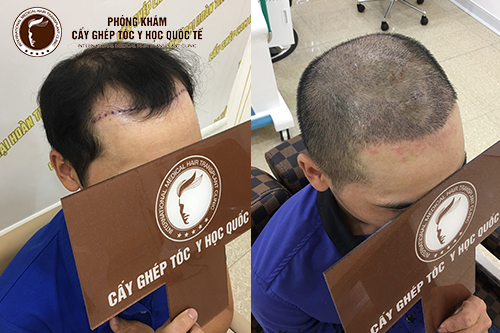 Giải đáp: Cấy tóc hết bao nhiêu tiền?