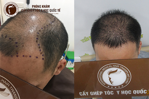 Cấy tóc khuyến mãi ngập tràn tại Phòng khám Cấy ghép tóc Y học Quốc tế