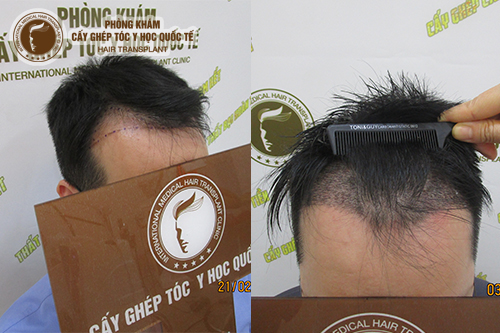 Chi phí cấy tóc đường chữ M có đắt không?