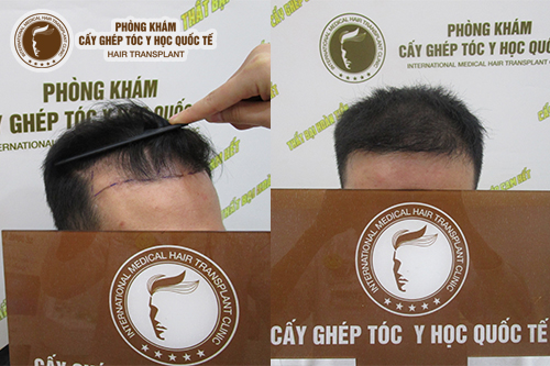 Giải đáp thắc mắc: Cấy tóc nam giá bao nhiêu?