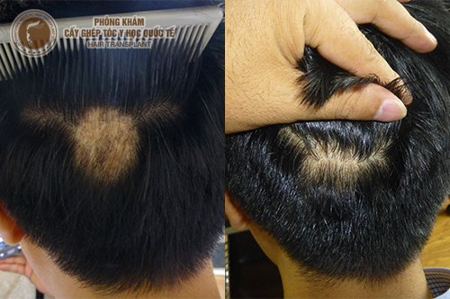 Chi phí cấy tóc trên sẹo là bao nhiêu?