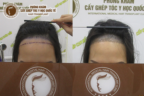 Cấy tóc vùng trán giải pháp loại bỏ “sân bay” nhanh chóng