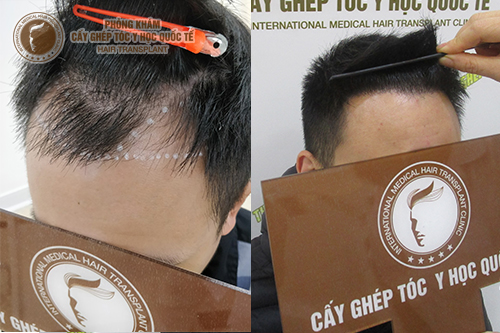 Đâu là cách trị hói trán cho nam giới hiệu quả nhất?