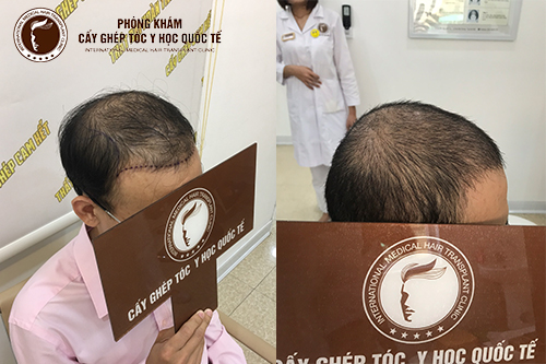 Tất tần tật từ a – z về công nghệ cấy tóc tự thân