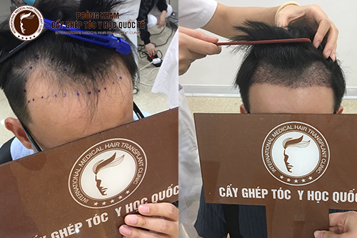 Cấy tóc ở đâu hiệu quả cho mái tóc dày chắc khỏe?