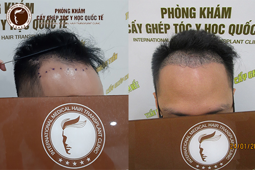 Giải đáp thắc mắc: Có nên đi cấy tóc không?