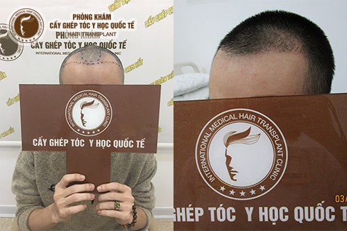 Review: Cấy tóc tự thân – Phương pháp “cứu cánh” cho người bị rụng tóc, hói đầu