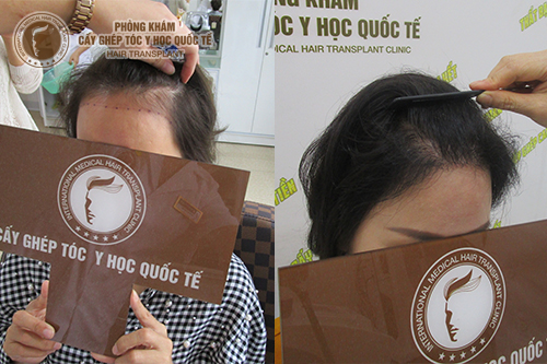 Cấy tóc cho người trán cao – Giải pháp giúp bạn lấy lại tự tin