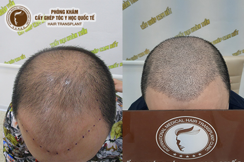 Quy trình cấy tóc hiệu quả và những điều cần lưu ý sau khi cấy tóc