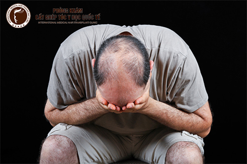 Cấy tóc nam – Giải pháp cải thiện vấn đề “mảng sân bay” cho phái mạnh