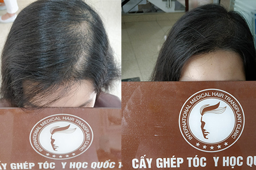 Top 5 cách chữa hói đầu ở nữ giới hiệu quả nhất