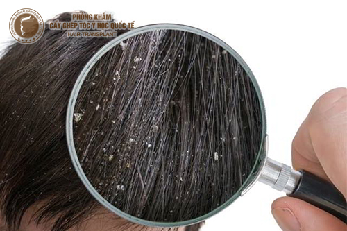 3 cách trị gàu và rụng tóc “thần kỳ” dễ làm tại nhà 