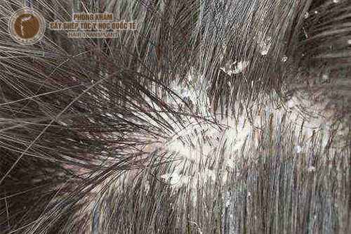 Bí quyết 3 bước trị tóc khô gàu hiệu quả