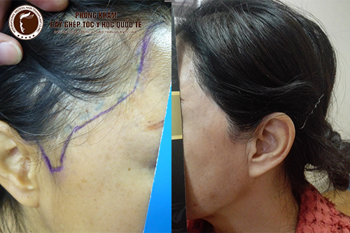 Cấy tóc mai – trả lại tuổi đôi mươi